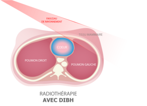 Nouvelle technique de radiothérapie du sein
